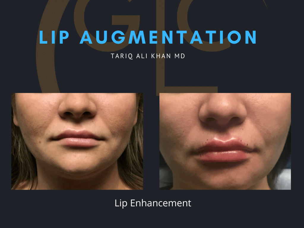 Gentle Care Laser Tustin Before and After picture - Lip Augmentation